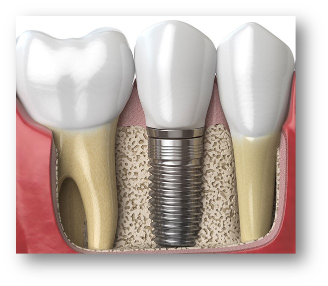 implante-dentario-protese-fixa-unitaria