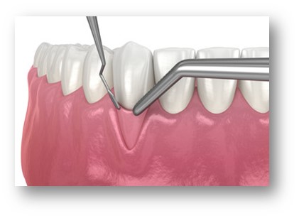 periodontia-enxertos-gengivais