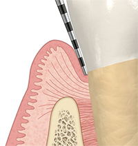 periodonti-200