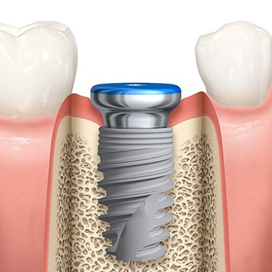 implante-pante-dentario