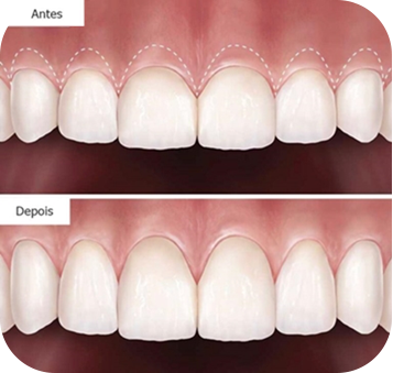 cirurgia-plastica-periodontal