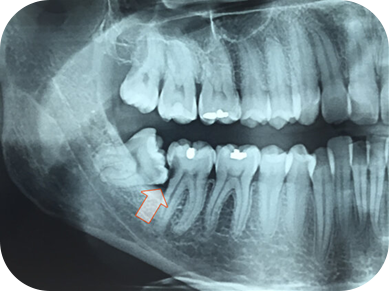 extracao-terceiro-molar